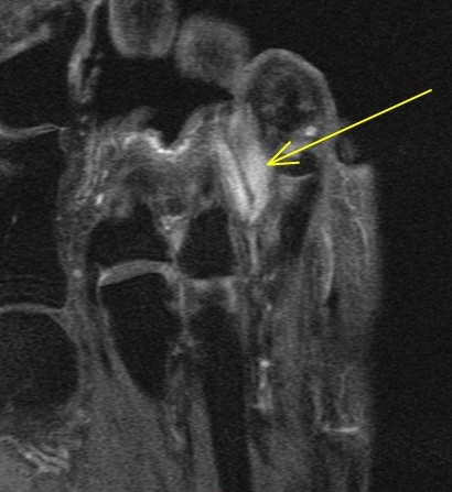 Figure 5 for case Nodular Localized Cutaneous Amyloidosis